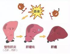 肝癌病人可以吃灵芝孢子粉吗？灵芝孢子粉对肝癌的治疗作用？